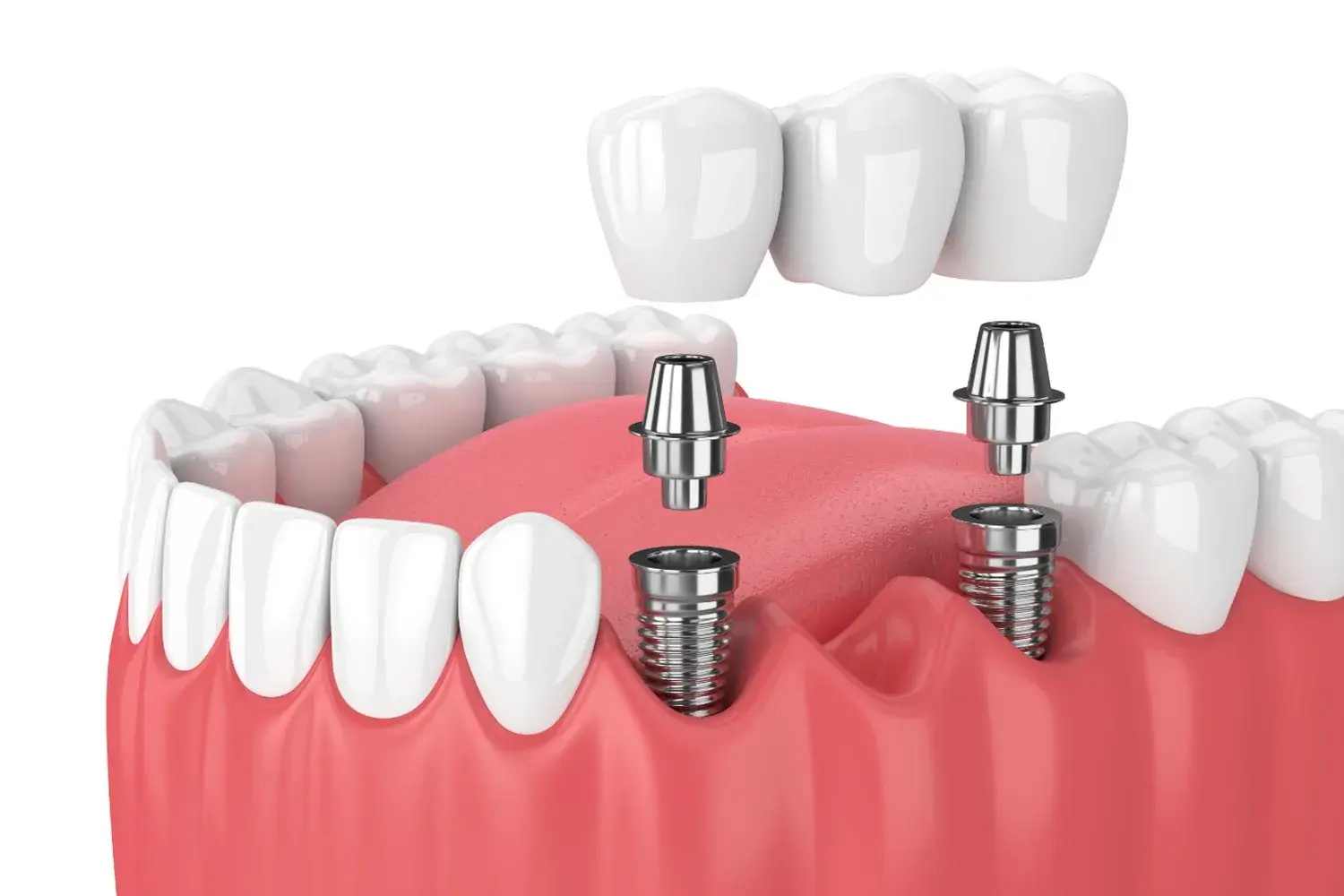 dental-prostheses2