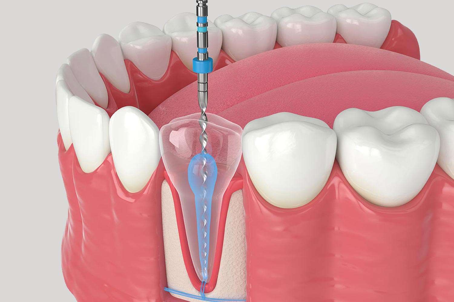 dental-pulp-treatment-1 dental-pulp-treatment-1